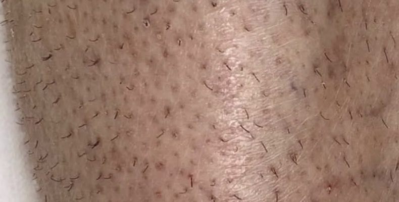 Nogi po 5 zabiegach lasera, przed